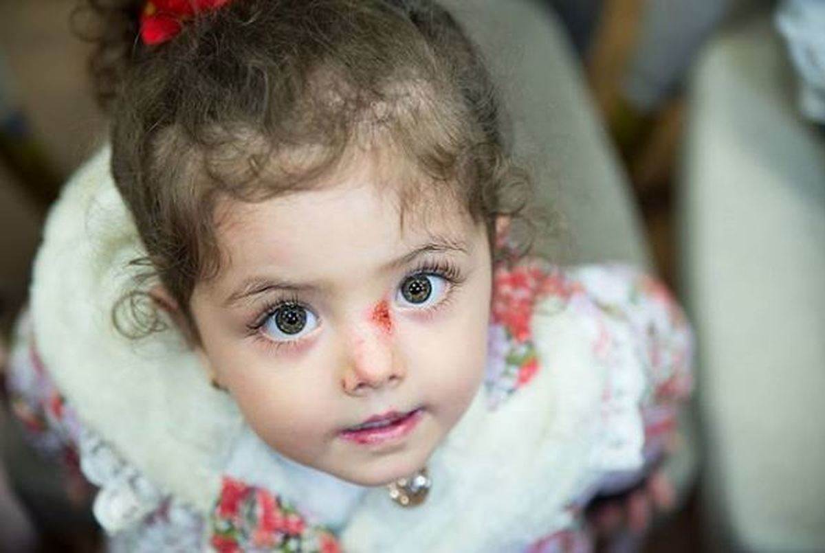 Iranian child suffering from epidermolysis bullosa