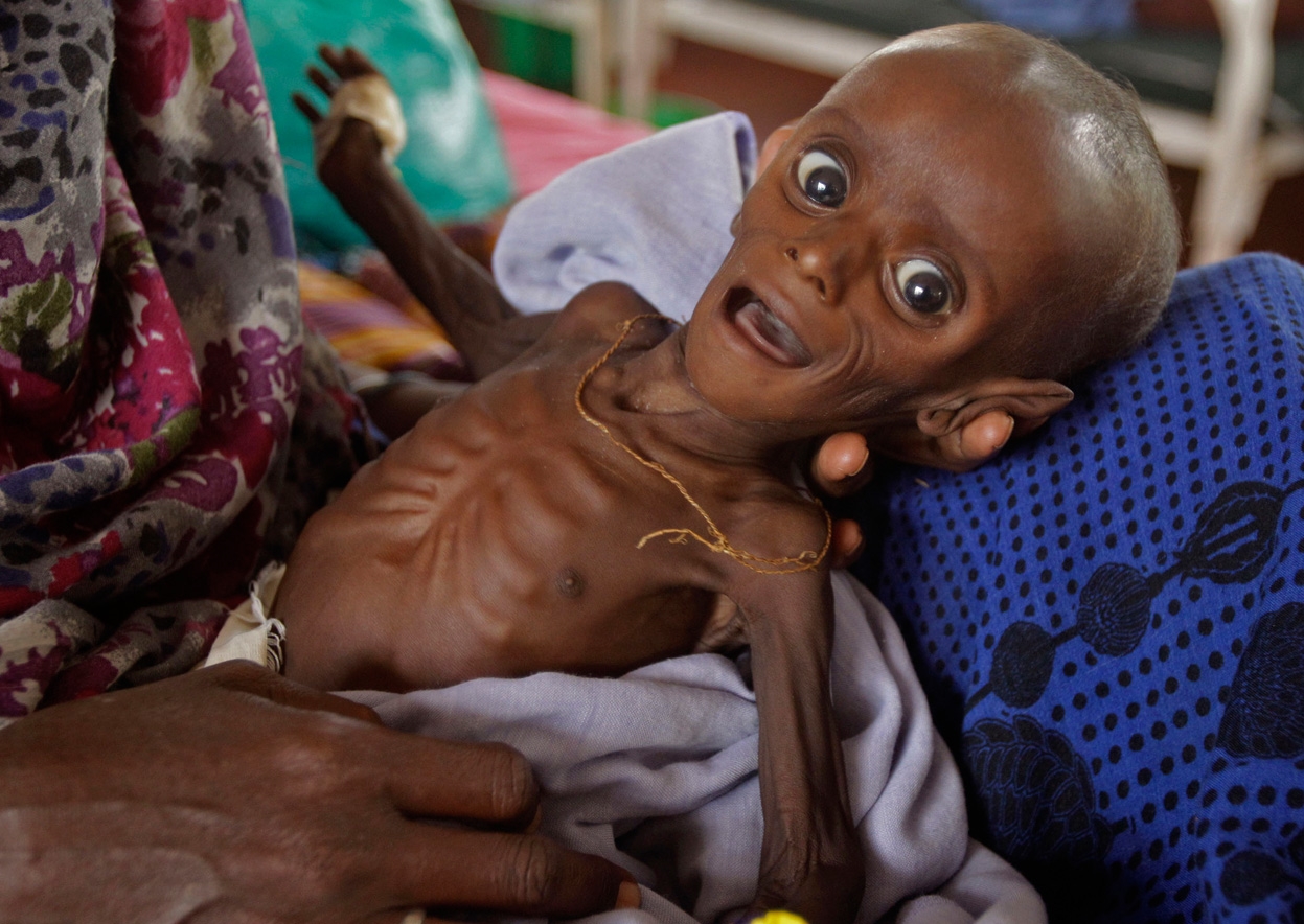 a malnourished seven-month-old child weighing only 7.5 pound (3.4kg), is held by his mother in a field hospital of the International Rescue Committee, IRC, in the town of Dadaab, Kenya, on July 26, 2011 | AP