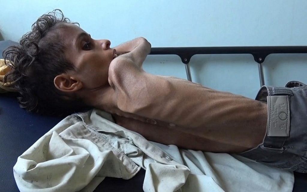 Ten year-old Ghazi Saleh, who weighs just ten kilograms, lies on a bed at Al-Mudhafar hospital in Taez, Yemen, on November 19, 2018. (AFP)