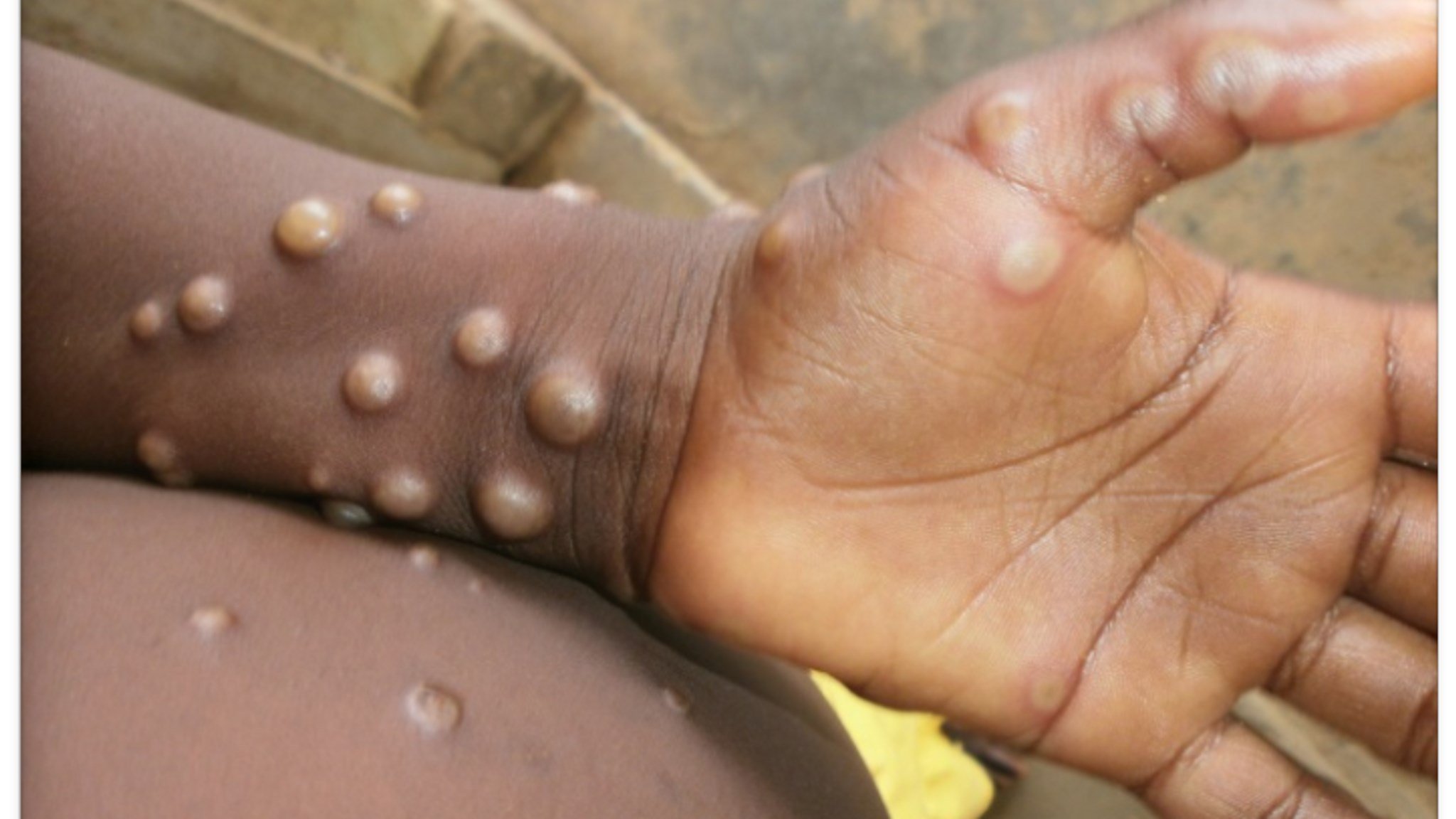 Cases of monkeypox are often found close to tropical rainforests (WHO)