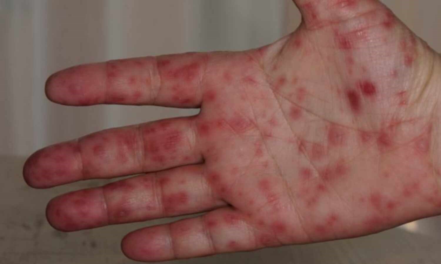 The tomato flu outbreak is sparking concerns all over India