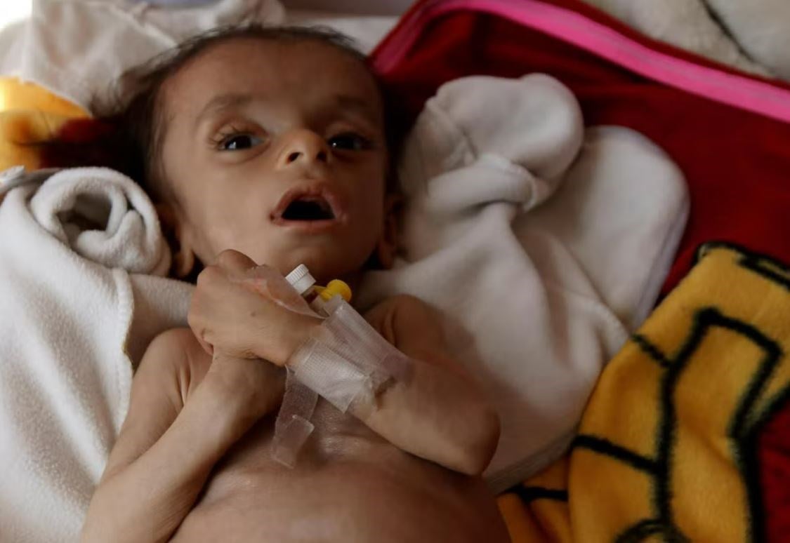 A Yemeni child suffering from acute malnutrition due to the Saudi-led war on Yemen. (Reuters)