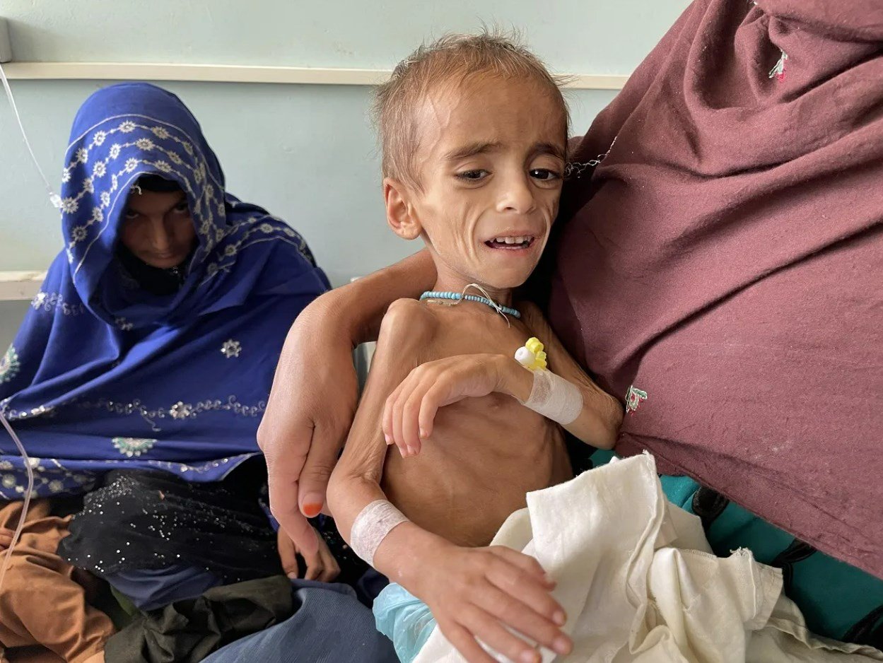 A malnourished Afghan child is treated at a hospital in Kandahar. (AFP)