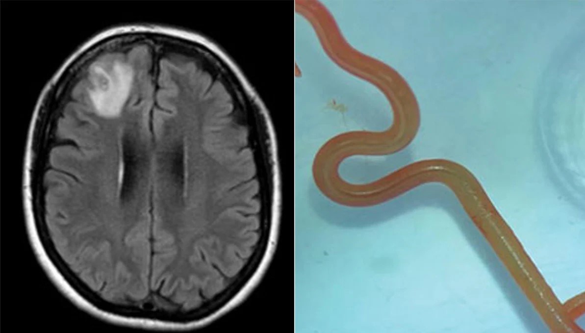 A photo showing the patient's brain scan and a photo of the roundworm (CDC.gov)