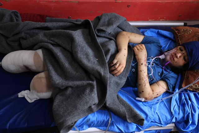 Amputations: Horrors of Israeli genocide on Gaza